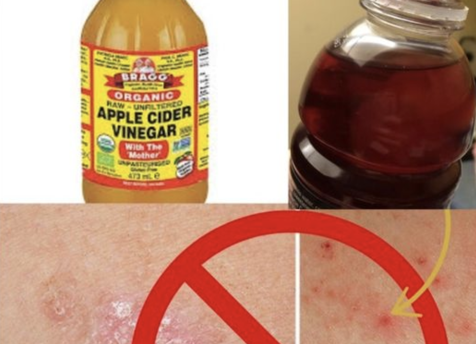 eczema with apple cider vinegar